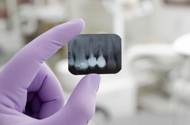 Kanały zębowe – co trzeba o nich wiedzieć? Poradnik dla pacjentów