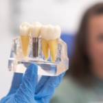 Implanty przeciwwskazania - dentysta trzymajacy model implantu zęba