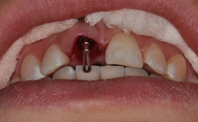 Natychmiastowe wprowadzenie implantu w zębodół poekstrakcyjny przyśrodkowego zęba siecznego górnego z wykorzystaniem naturalnej części koronowej zęba jako tymczasowej rekonstrukcji – opis przypadku
