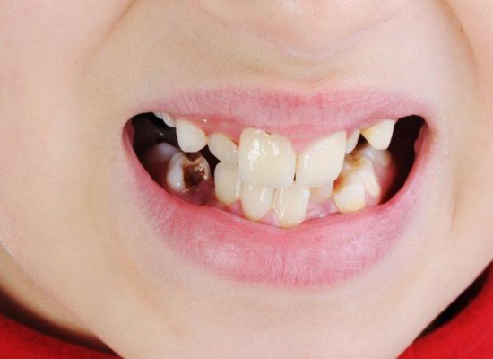 Polskie dzieci mają coraz większe problemy z zębami