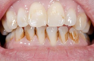 dirty teeth