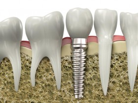 implant graph