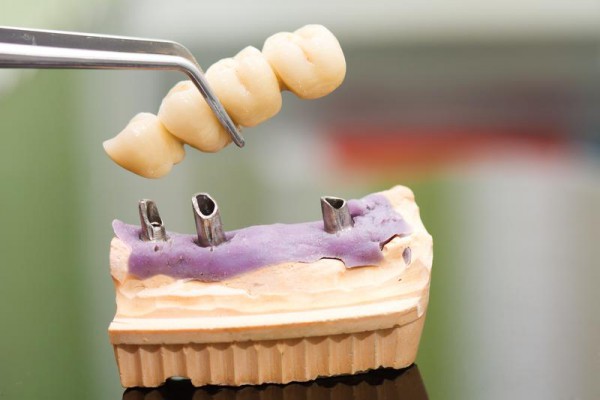 Cementowanie koron na implantach