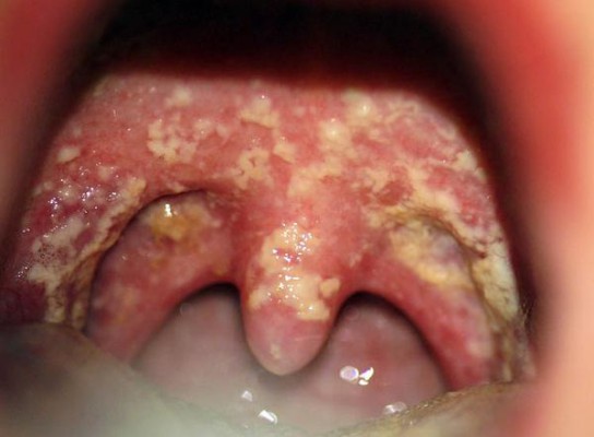 Co to jest kandydoza jamy ustnej