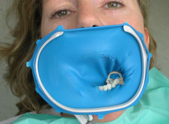 Koferdam w stomatologii odtwórczej – czy jest skuteczny?