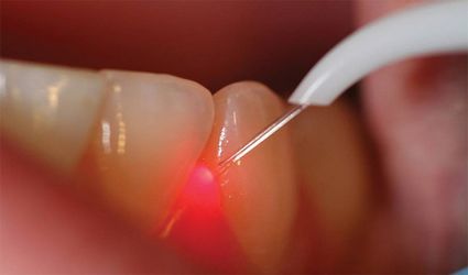 Nie więcej niż 10% polskich dentystów korzysta z laserów