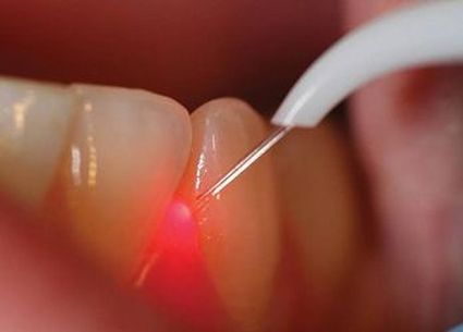 Rozwój urządzeń laserowych w stomatologii jest błyskawiczny