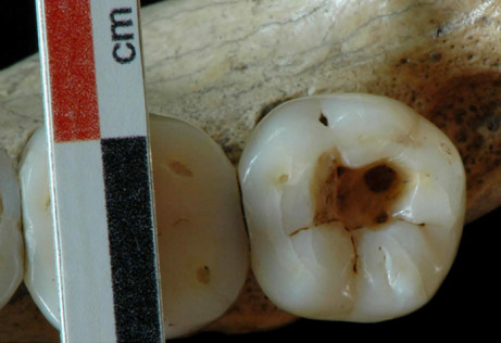 Dentystyczna interwencja z epoki późnego paleolitu