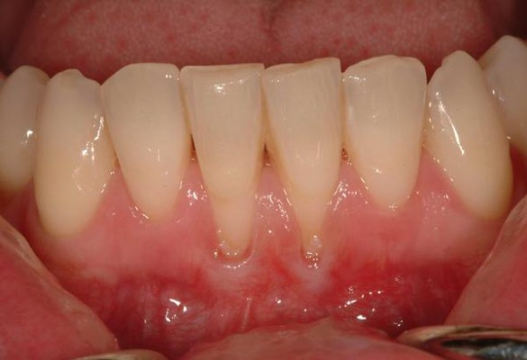 Czy parodontoza jest chorobą wyleczalną?