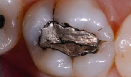 Wypełnienia stosowane w stomatologii: amalgamaty