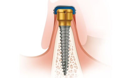 Nowość! Wąskie implanty (2,4 mm) BIOMET3i