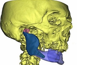 Implant z drukarki 3D – szczegóły operacji