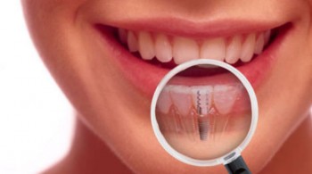 Dentonet - implanty zębowe