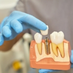 Powikłania po wszczepieniu implantu zębowego - dentysta prezentujący model zębów z implantem