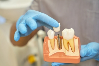 Powikłania po wszczepieniu implantu zębowego - dentysta prezentujący model zębów z implantem