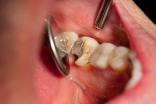 Dentonet - powikłania nieleczonej próchnicy