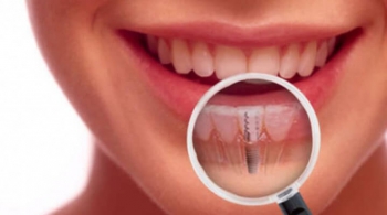 Implantacja zęba