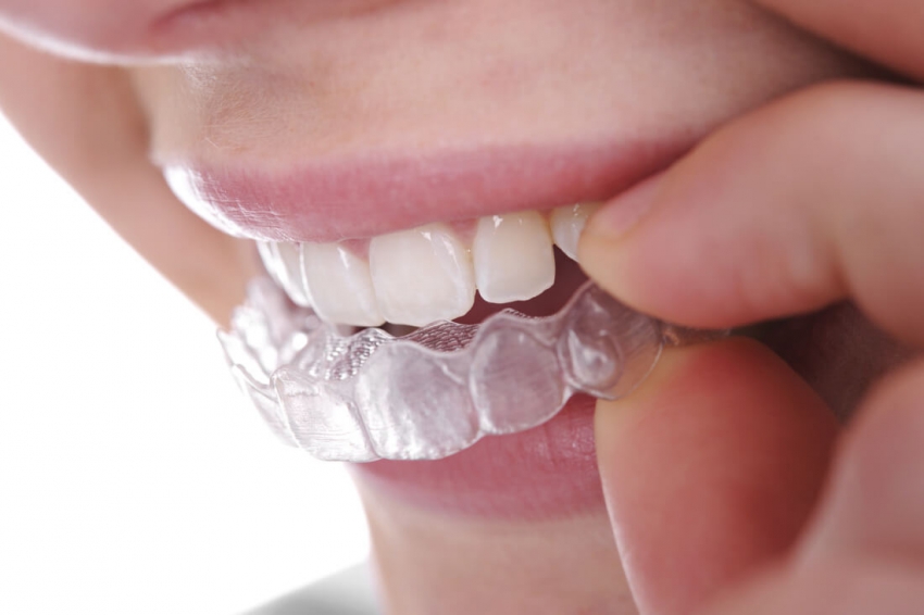 Znaczenie aparatów retencyjnych w leczeniu ortodontycznym