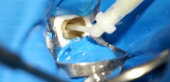 Racjonalne opracowanie kanału oraz najczęstsze błędy endodoncji