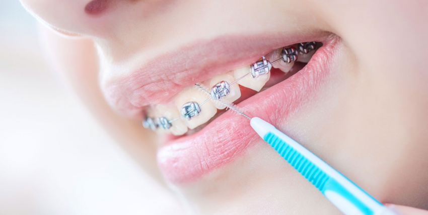 Zalecenia higienizacyjne – pacjent ortodontyczny