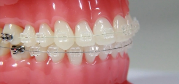 aparaty ortodontyczne - Dentonet.pl