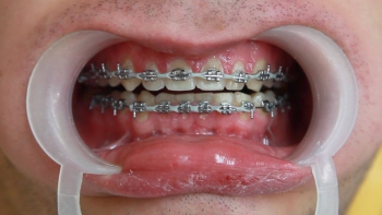 leczenie ortodontyczne 850x478