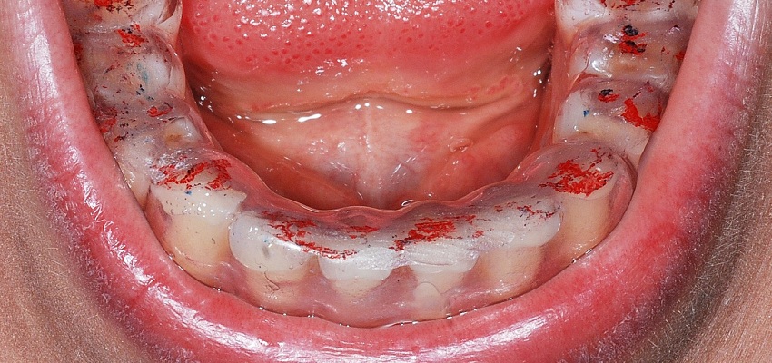 Zastosowanie szynoterapii w leczeniu powikłań po ortodoncji