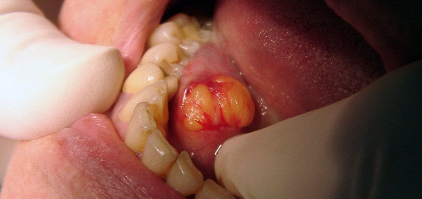 Tłuszczak dna jamy ustnej u 81-letniej kobiety  – opis przypadku