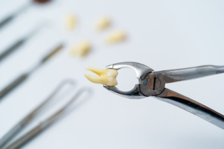 Powikłania po usunięciu zęba - usunięty ząb w szczypcach dentystycznych