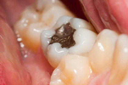 Na NFZ wkrótce tylko „białe zęby”?