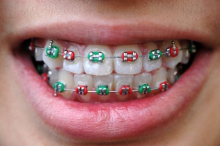 aparat ortodontyczny - Dentonet.pl