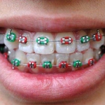 aparat ortodontyczny - Dentonet.pl