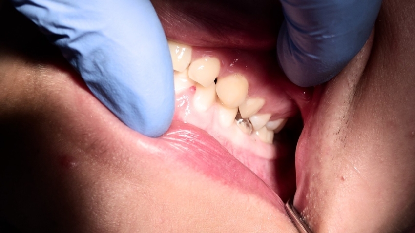 Przetrwały ząb mleczny – podwyższenie do okluzji (opis przypadku)