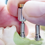 Implanty - Dentonet.pl