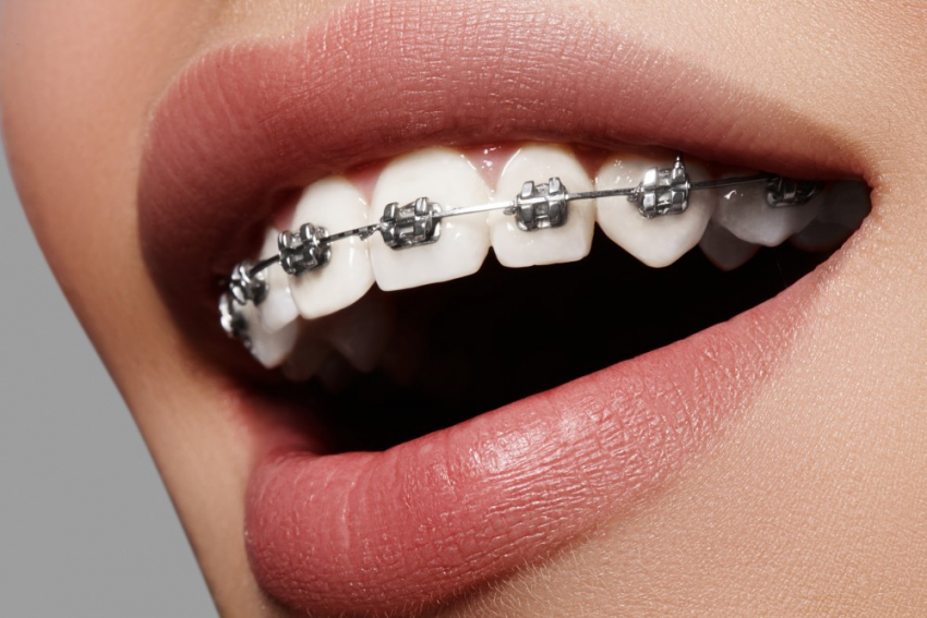 Leczenie protetyczne dla dopełnienia leczenia ortodontycznego?