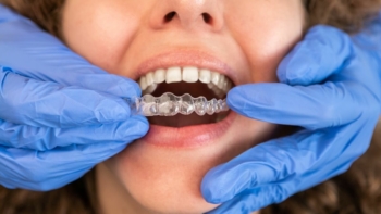 Leczenie bruksizmu - dentysta przymierzający pacjentce szynę relaksacyjną