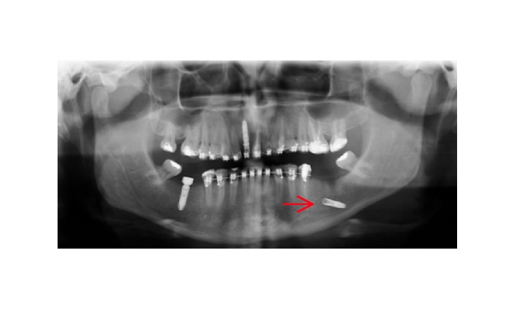Ropowica jamy ustnej jako skutek przemieszczenia implantu