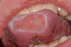 Plazmocytarne zapalenie błon śluzowych języka 1