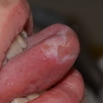 Plazmocytarne zapalenie błon śluzowych języka 2