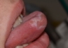 Plazmocytarne zapalenie błon śluzowych języka u 14-latka