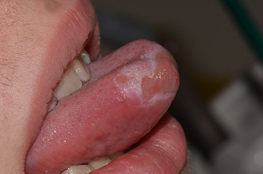 Plazmocytarne zapalenie błon śluzowych języka u 14-latka
