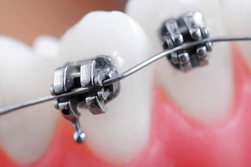 „Scientific American”: Miękka dieta przyczyną stłoczeń zębów