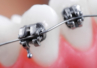 "Scientific American": Miękka dieta przyczyną stłoczeń zębów