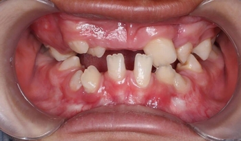 syndrom Gorlina-Goltza - Dentonet.pl