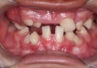 Syndrom Gorlina-Goltza – zmiany w jamie ustnej 9-latka