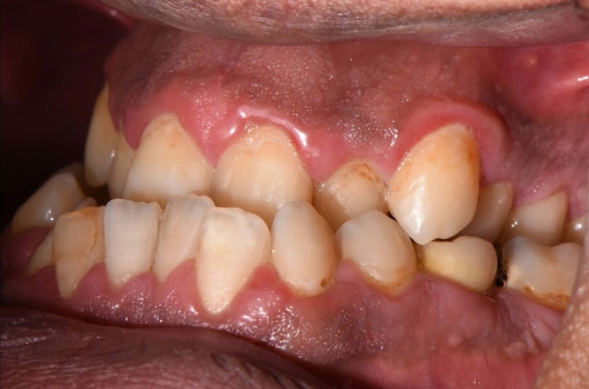Wydłużone korzenie zębowe – rzadki przypadek radykulomegalii