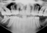 Wydłużone korzenie zębowe – rzadki przypadek radykulomegalii