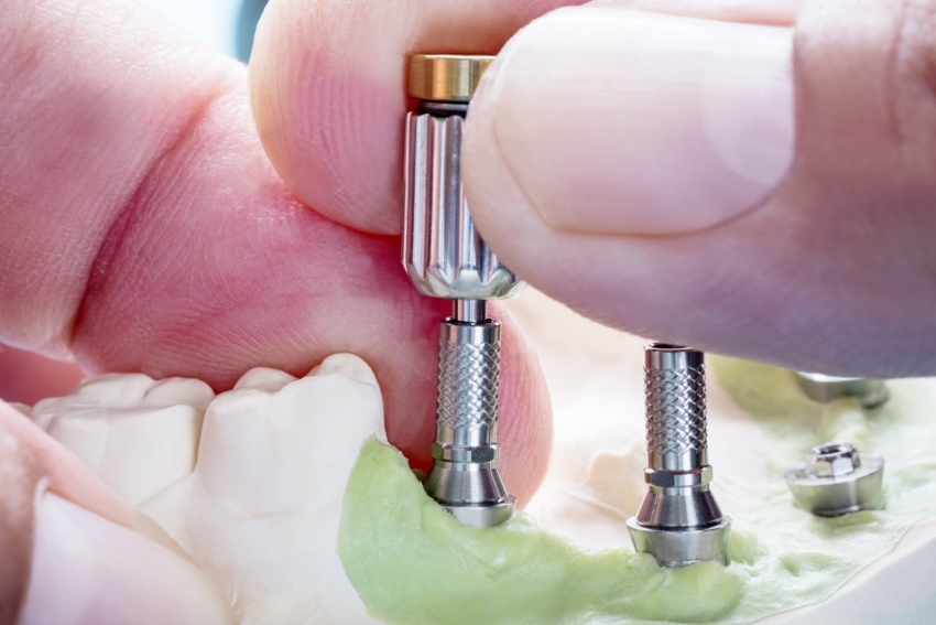 Dentystka z czasowym zakazem leczenia implantologicznego