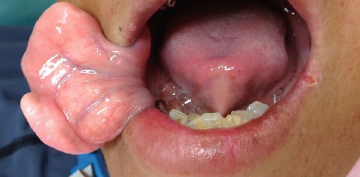Resekcja ogromnego tłuszczaka przedsionka jamy ustnej