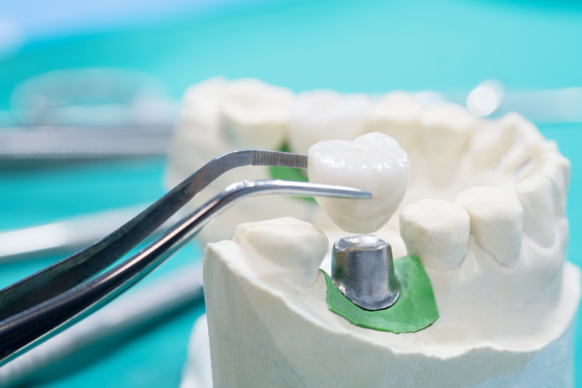 Austria: ekspresowe implantacje zębów u dentofobów